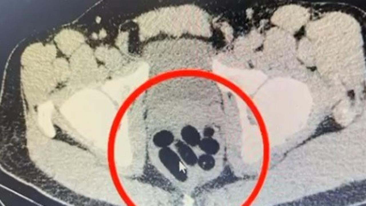 kayseride uyusturucu operasyonu midesinden cikan soke etti PMIzVEMu.jpg